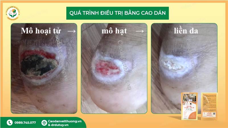 quá trình điều trị vết thương gót chân bằng cao