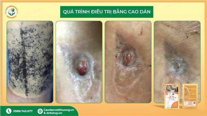 quá trình điều trị vết thương hoại tử bằng cao dán