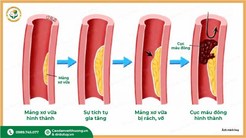 quá trình hình thành xơ vữa động mạch