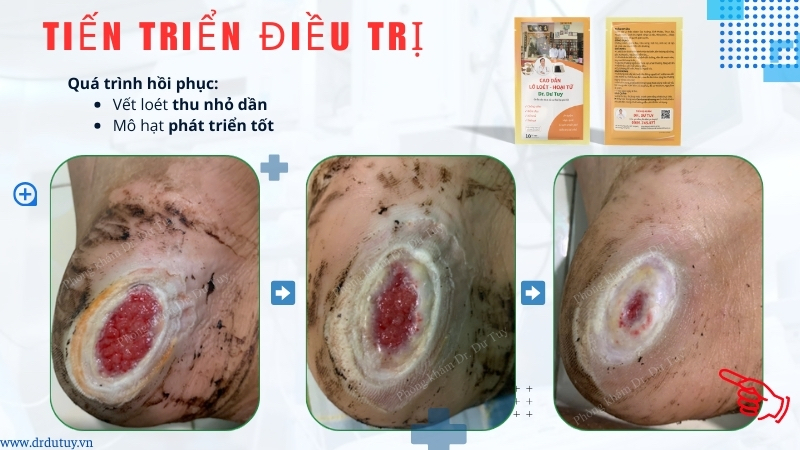 quá trình hồi phục lở loét gót chân
