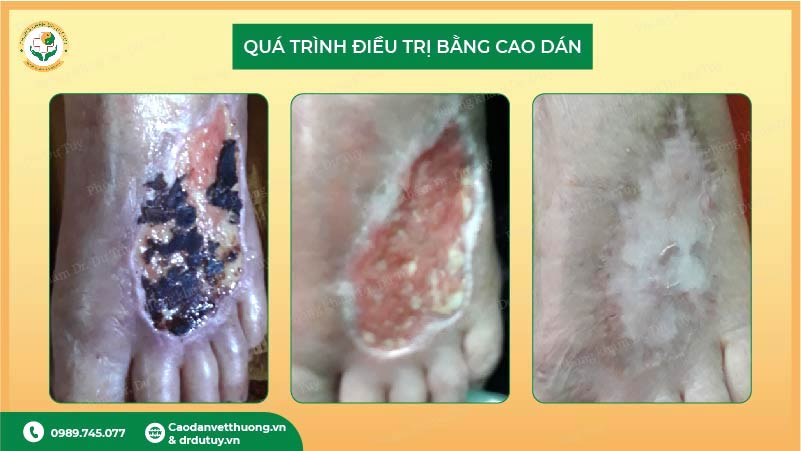 quá trình hồi phục vết loét bàn chân bằng cao dán