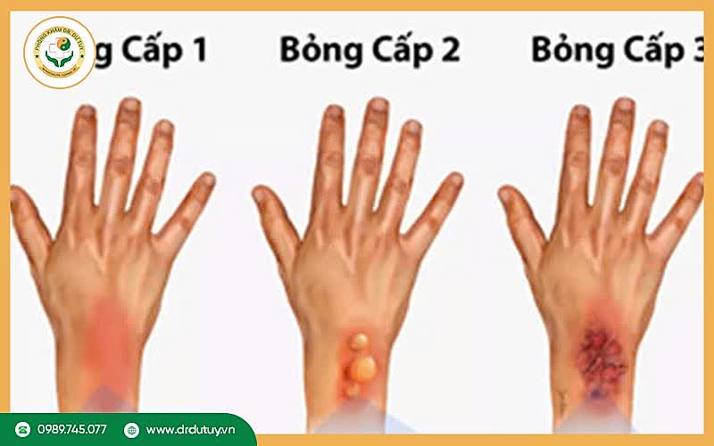 Nhận biết mức độ bỏng