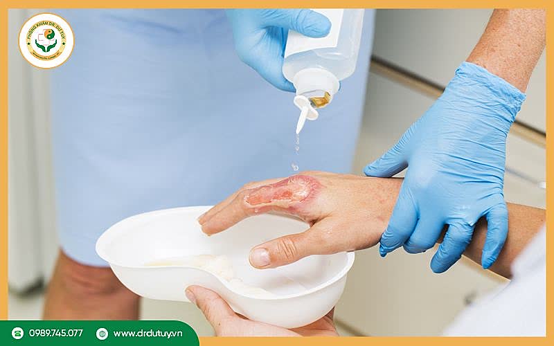 Cách chữa vết bỏng bị phồng rộp an toàn và hiệu quả