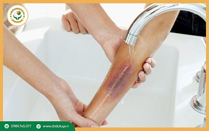 Chế độ chăm sóc vết bỏng