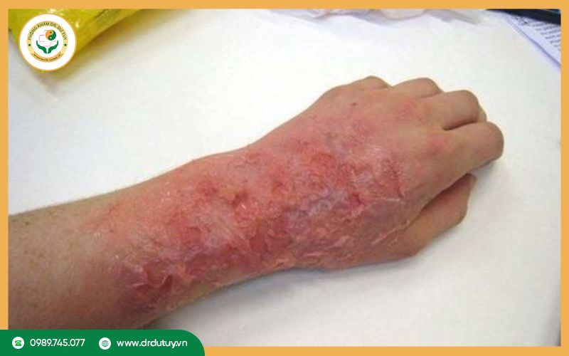 Quá trình lành vết bỏng là gì?