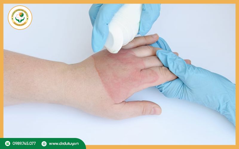 Cách chăm sóc hỗ trợ quá trình lành vết bỏng tại nhà