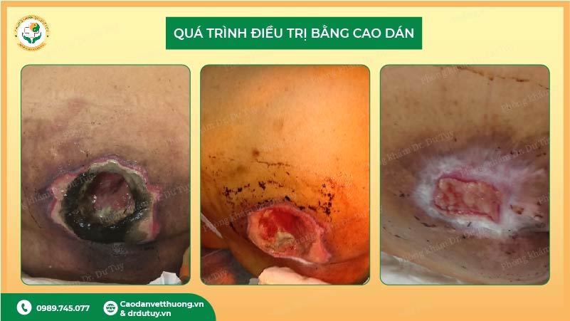 quá trình thu nhỏ vết loét khi dùng cao dán