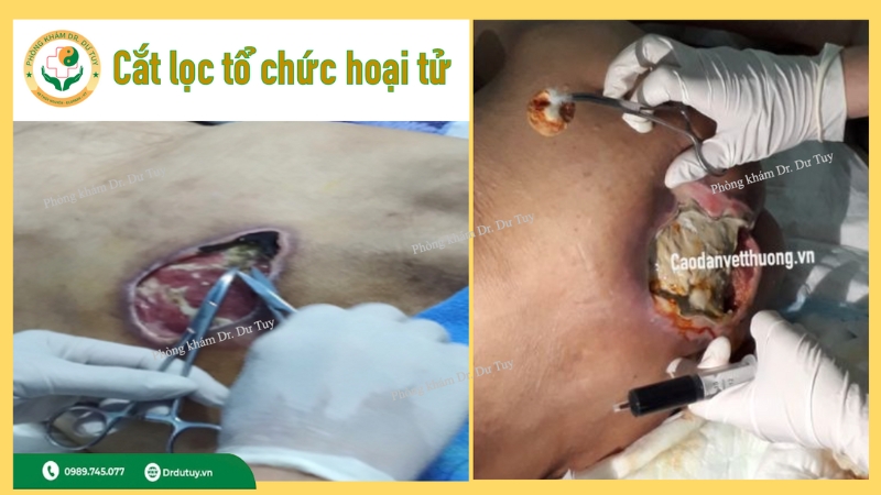 quy trình cắt lọc vết thương