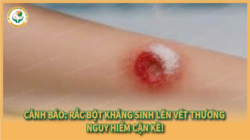 Cảnh báo: Rắc bột kháng sinh lên vết thương – Nguy hiểm cận kề!