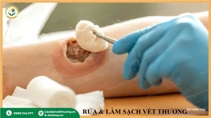 rửa làm sạch vết lở loét tại bệnh viện