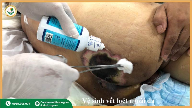 rửa vết loét sâu trước khi dán cao