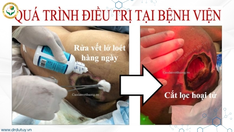 rửa vết loét và cắt lọc hoại tử tại bệnh viện