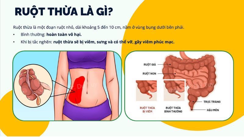 ruột thừa bị viêm sưng tắc nghẽn nguy hiểm
