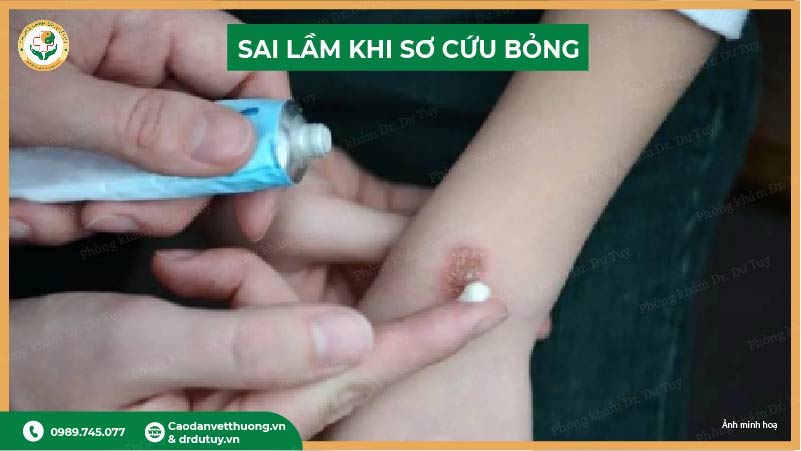 sai lầm khi sơ cứu bỏng