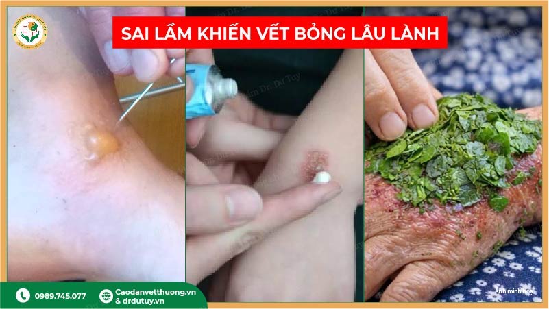 sai lầm khi trị bỏng