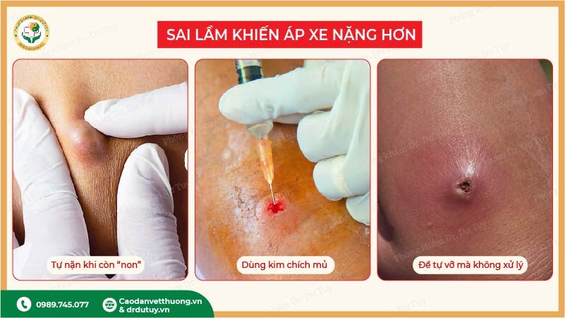 sai lầm khi trị mụn nhọt áp xe