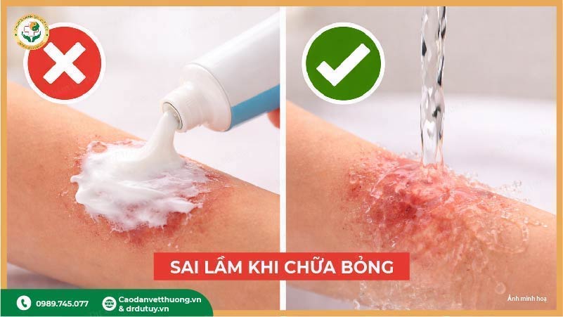 sai lầm khi xử lý bỏng kem đánh răng
