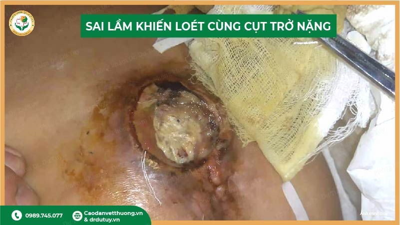 sai lầm khiến loét cùng cụt trở nặng