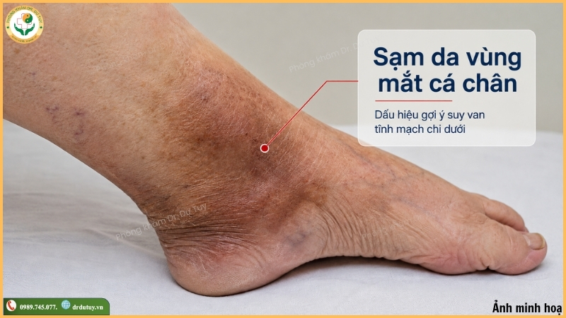sạm da vùng mắt cá chân do suy tĩnh mạch