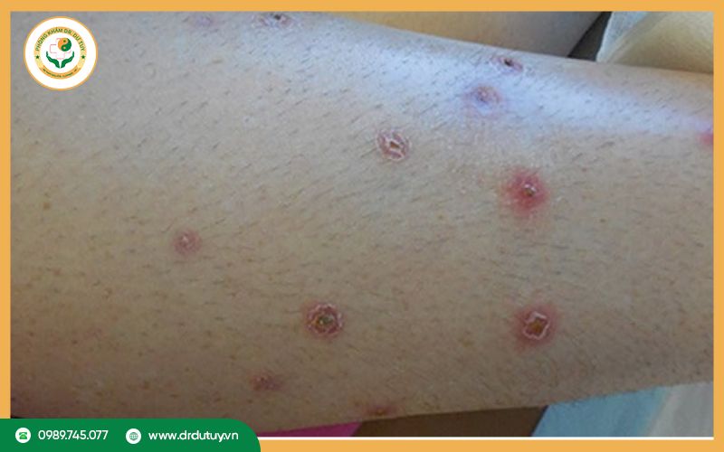 Sản phẩm nào điều trị viêm da mủ lở loét hiệu quả?