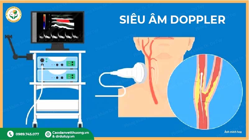 siêu âm doppler chẩn đoán xơ vữa động mạch