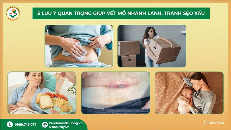 sinh mổ bao lâu thì lành