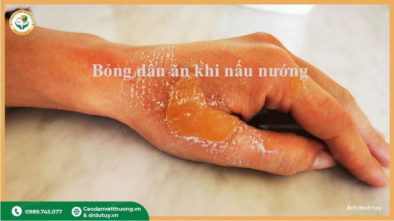 sơ cưu bỏng dầu ăn