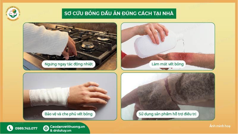 sơ cứu bỏng tại nhà