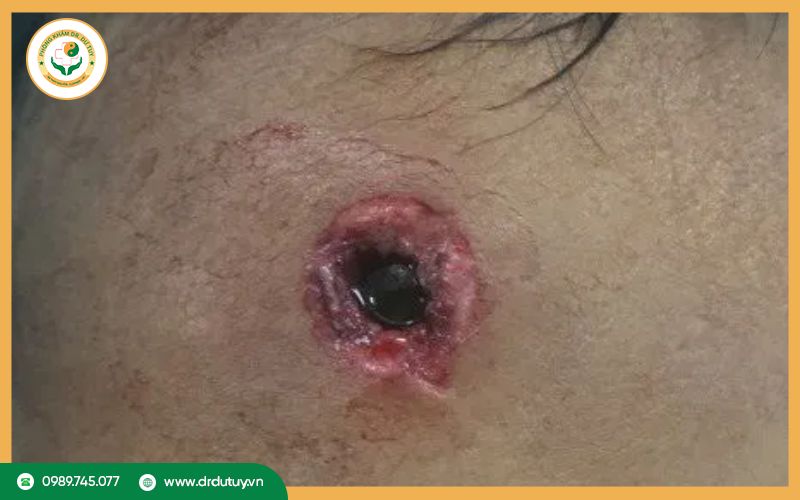 Một số vết thương cần sơ cứu thường gặp