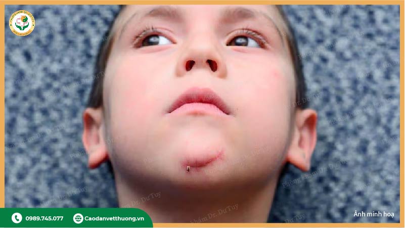 sơ cứu vết thương trẻ nhỏ