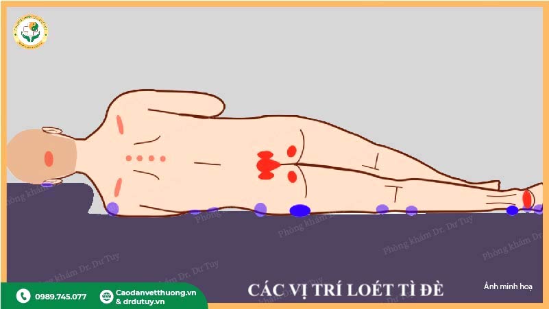 sơ đồ loét tì đè người nằm lâu