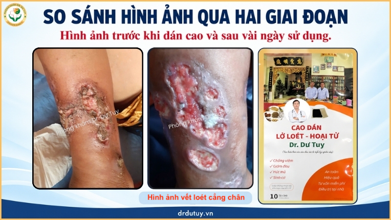 so sánh vết loét hai giai đoạn