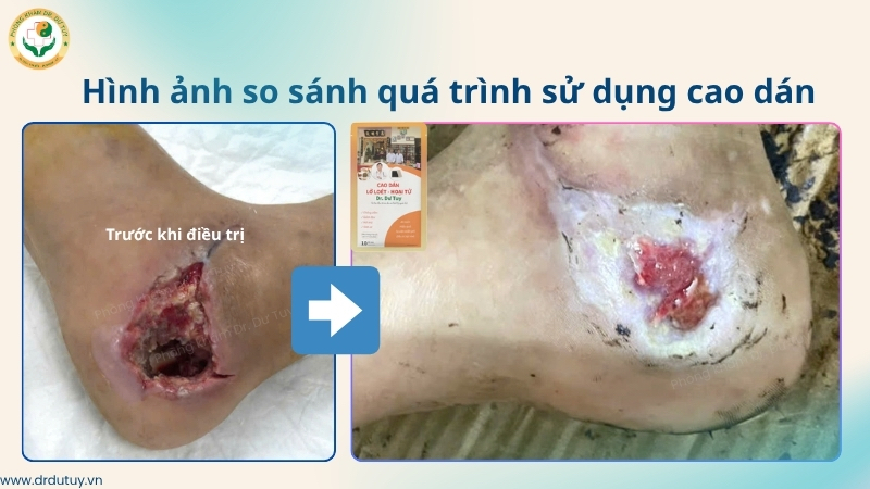 so sánh vết thương gót chân trước và sau khi dùng cao dán