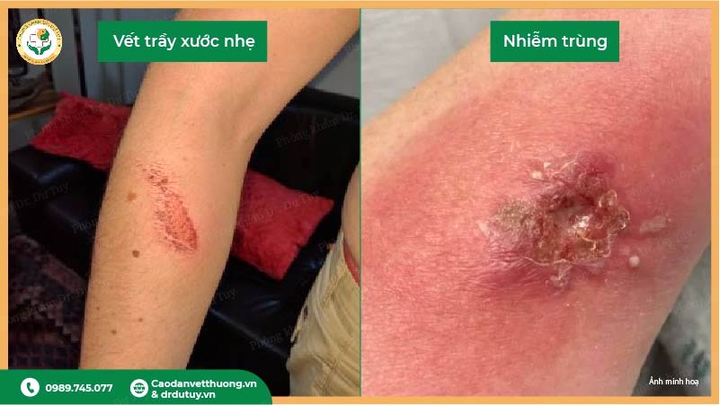 so sánh vết trầy xước nhẹ và nhiễm trùng