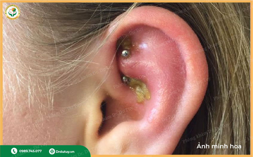 sưng đỏ vành tai