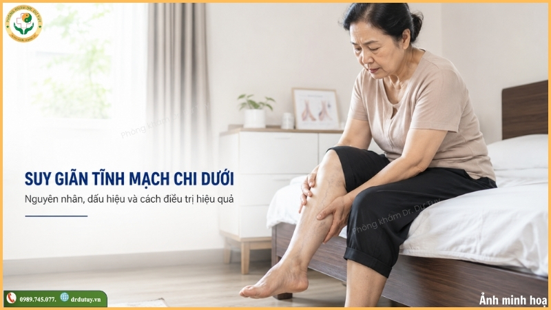 suy giãn tĩnh mạch chi dưới, nguyên nhân, dấu hiệu, điều trị