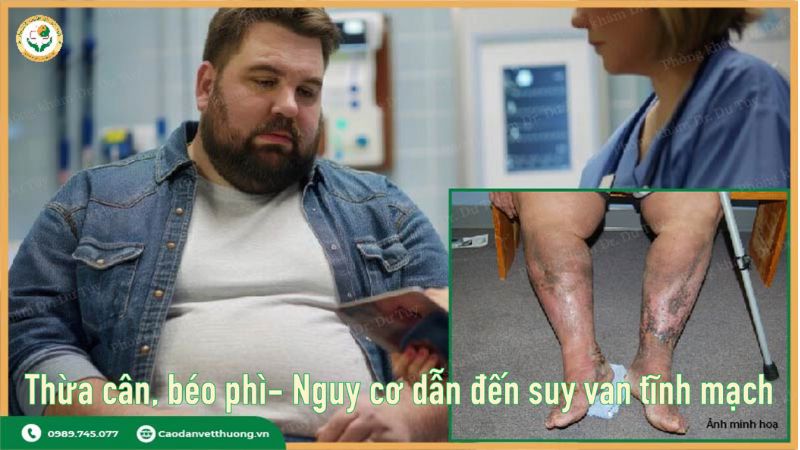 suy van tĩnh mạch sâu chi dưới