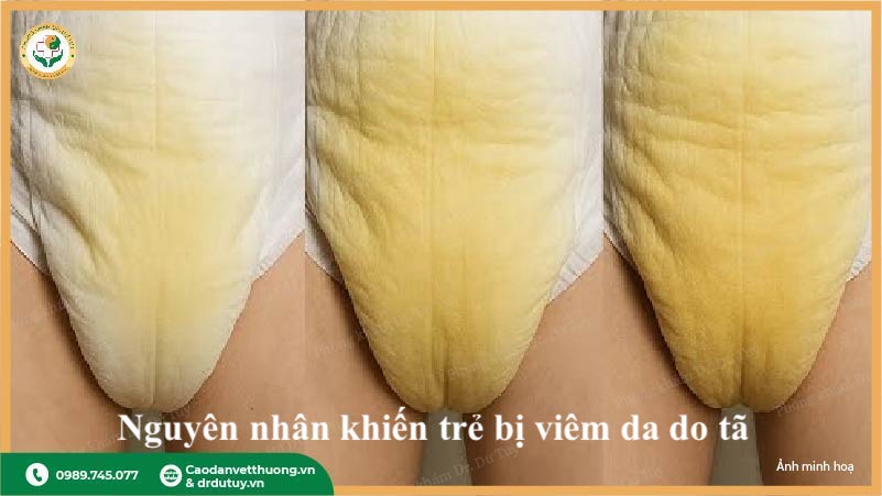 tã ẩm ướt quá lâu nguyên nhân gây viêm da do tã