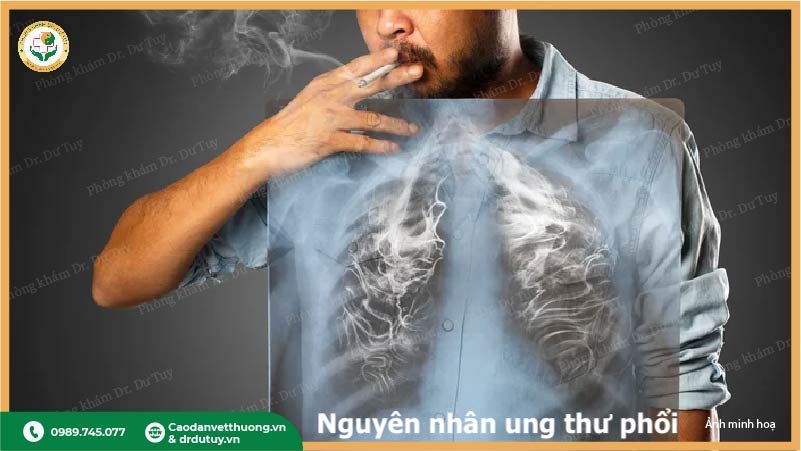 tác hại hút thuốc gây ung thư phổi
