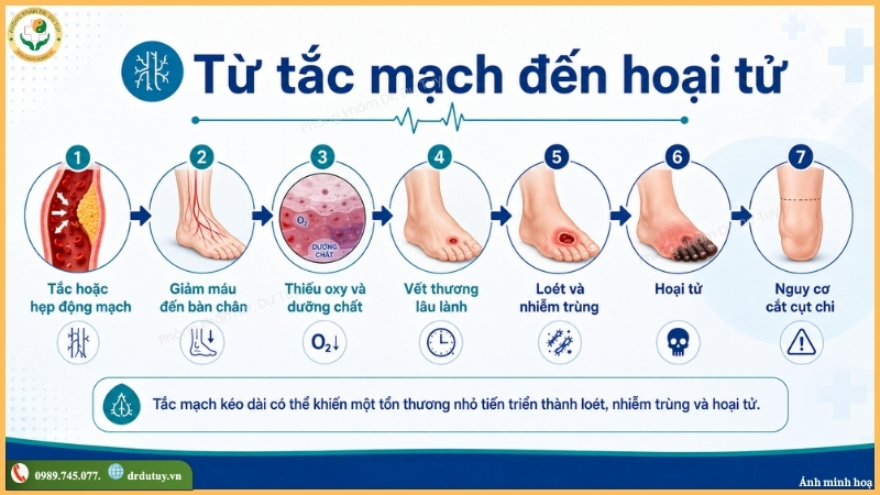 tắc mạch chi dưới dẫn đến hoại tử