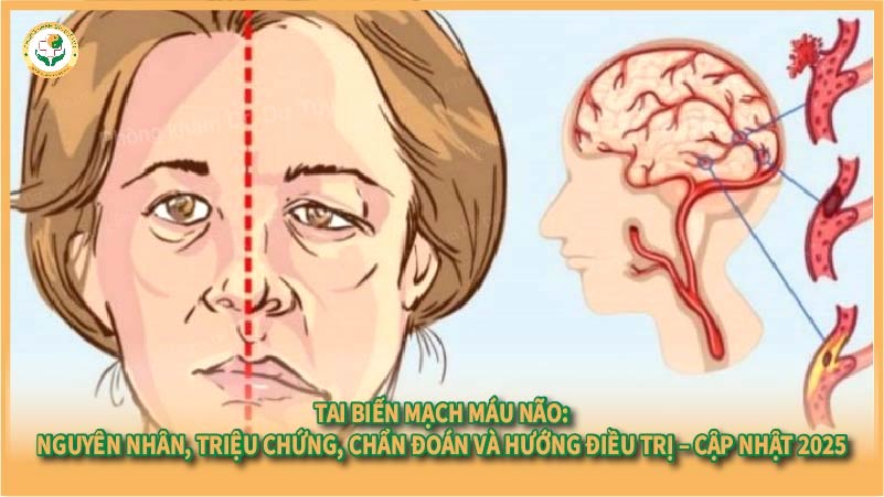 Tai biến mạch máu não: Nguyên nhân, triệu chứng, chẩn đoán và hướng điều trị – Cập nhật 2025