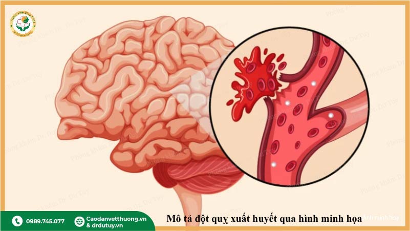 tai biến mạch máu não là gì?