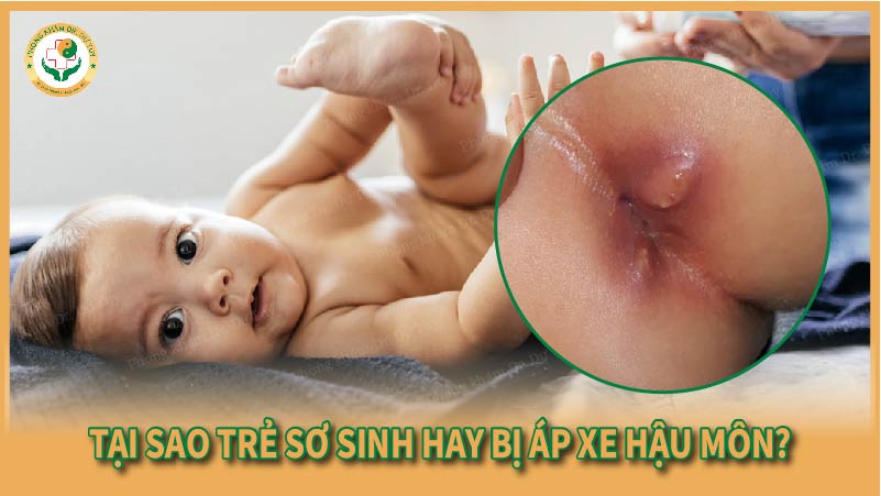 Tại sao trẻ sơ sinh hay bị áp xe hậu môn?