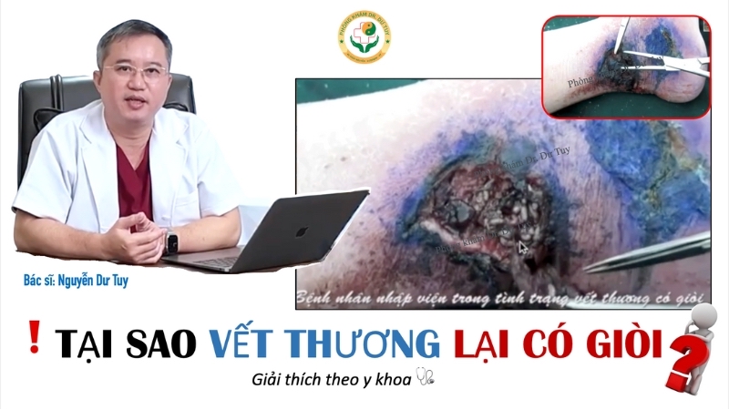 Tại sao vết thương lại có giòi – Sai lầm khi xịt, bôi, rắc thuốc ngoài da