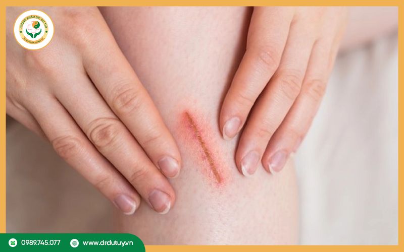 Tại sao vết thương lâu lành? Cách chăm sóc hiệu quả