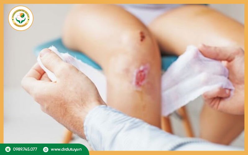 Hướng dẫn chăm sóc vết thương giúp nhanh lành