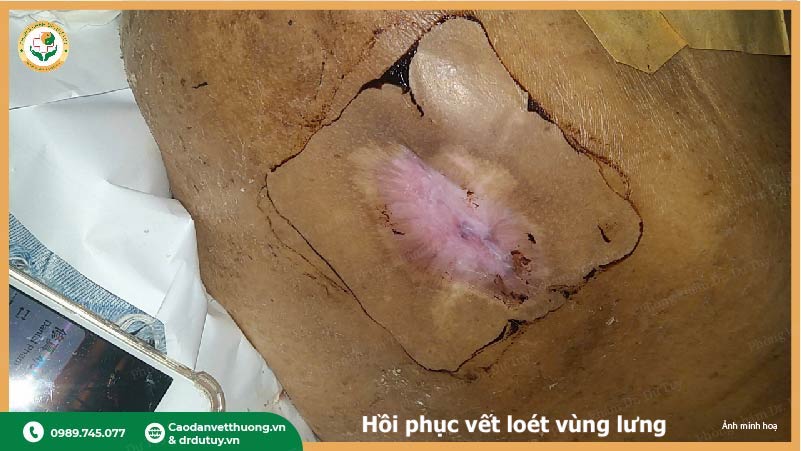 tái tạo da sau vết loét