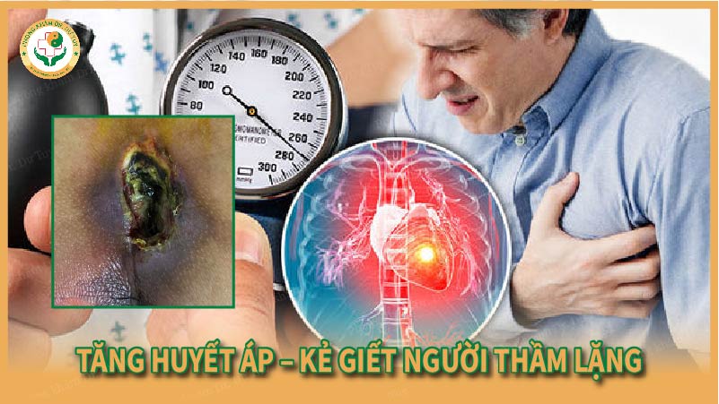 Tăng huyết áp – Kẻ giết người thầm lặng