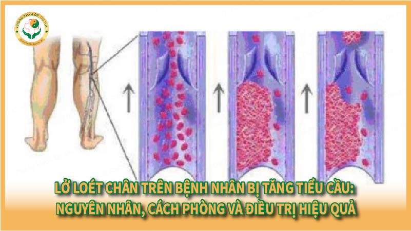 Lở loét chân trên bệnh nhân bị tăng tiểu cầu: Nguyên nhân, cách phòng và điều trị hiệu quả