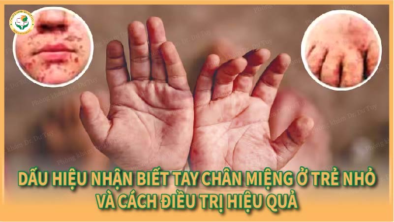 Dấu hiệu nhận biết tay chân miệng ở trẻ nhỏ và cách điều trị hiệu quả